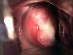 Maren Arnold Hannover - Fotze Muttermund Cervix.avi