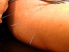 Acupuncture 2