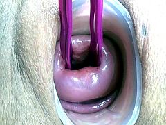 Prolapsed Cervix Lesbians at the same time